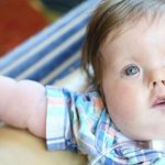 синдром мебиуса симптомы