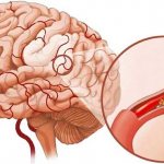 склероз сосудов головного мозга