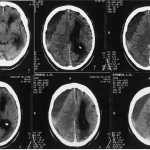 Displacement of brain structures
