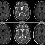 Снимок КТ головного мозга