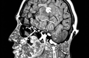 Left Frontal Cortex Function Cyst CSF cyst of the brain: signs, symptoms, treatment