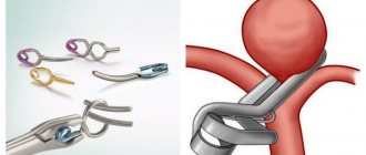 Сосудистые клипсы