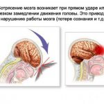 Brain concussion