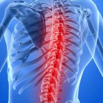 Спинальный инсульт. Aksimed.ua.