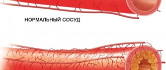 vasoconstriction