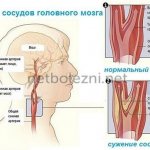 Сужение сосудов головного мозга