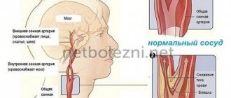 Constriction of blood vessels in the brain