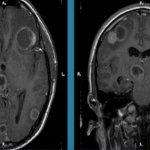 Toxoplasmosis on MRI of the brain