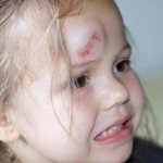 Травма головы у девочки