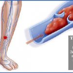 Тромбофлебит нижних конечностей