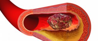 Thrombosis