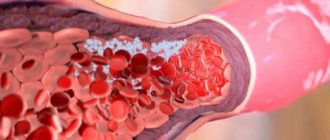 Blood clots on MRI