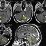 Удаление опухоли червя мозжечка и четвертого желудочка