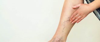 Venous insufficiency of the lower extremities: how to eliminate the problem