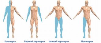 виды парезов