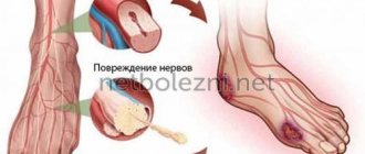 Возникновение нейропатии конечностей