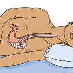 зондовое питание